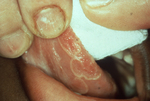 Geographic tongue (Erythema migrans)