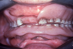 Inflammatory papillary hyperplasia (IPH, Dentures)