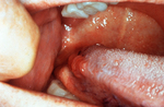 Enlarged lingual tonsil