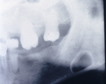 Lingual mandibular salivary gland depression