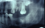 Focal osteoporotic marrow defect